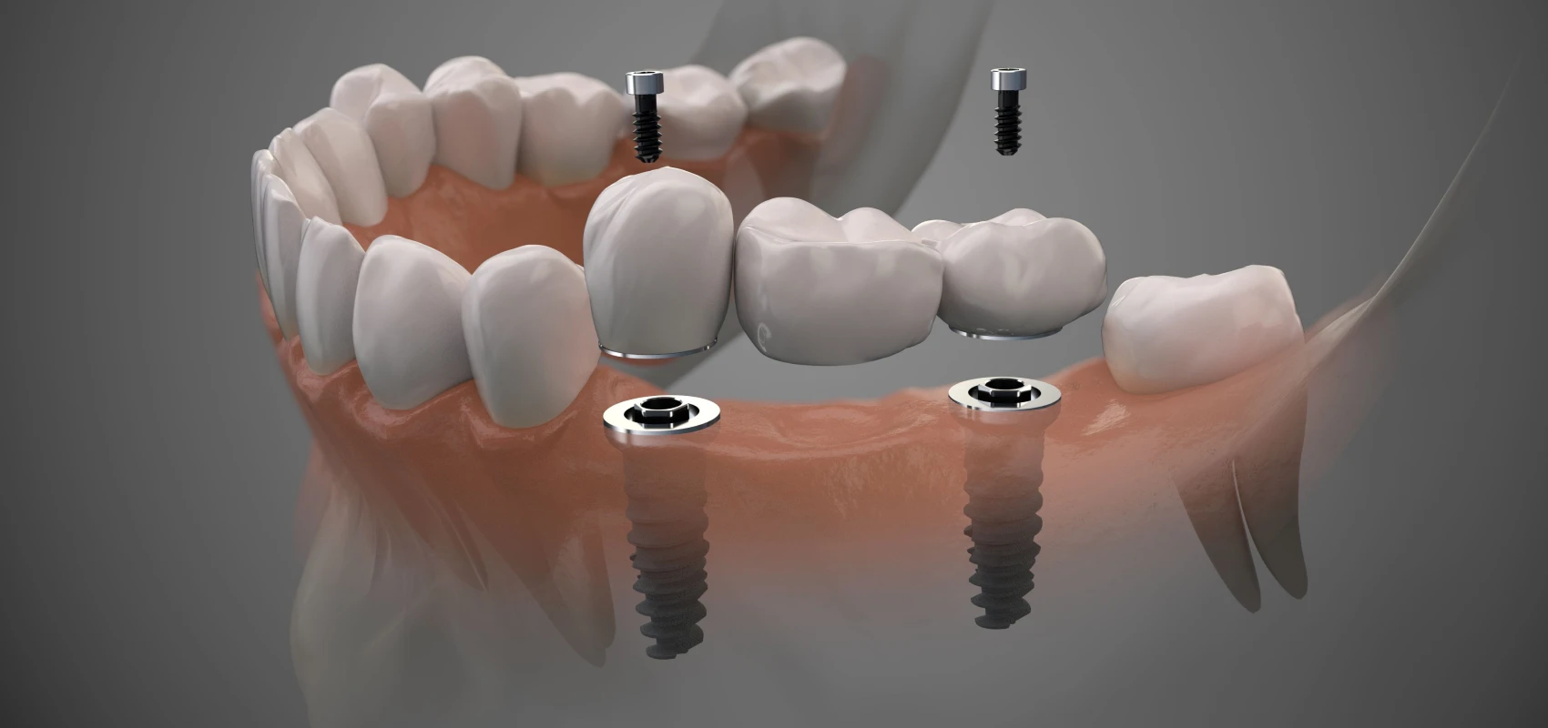 Couronnes et bridges sur implants- Prothèses sur implants Cannes 06400