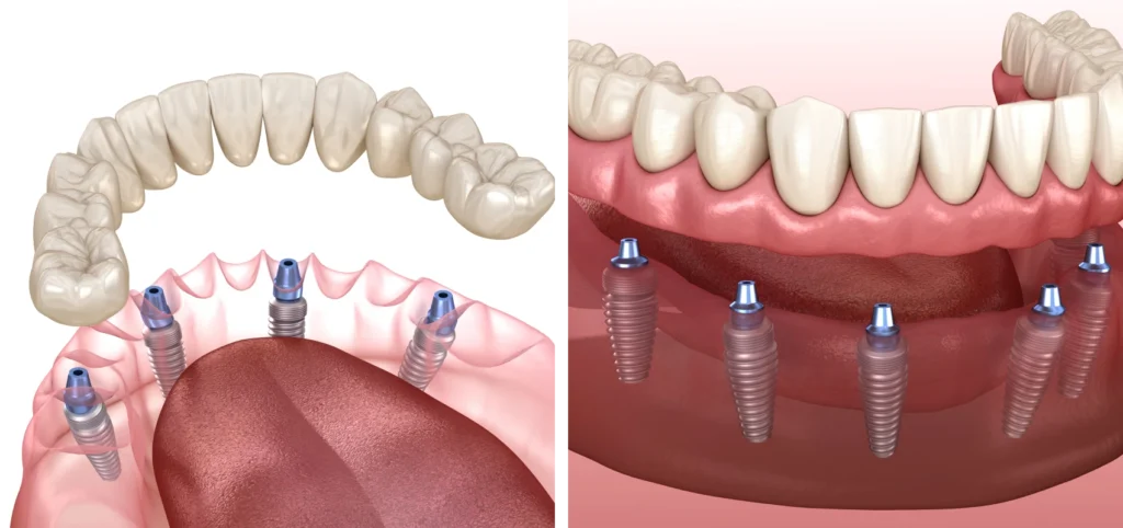 Implant complet - Dentistes à Cannes 06400, sur la Croisette