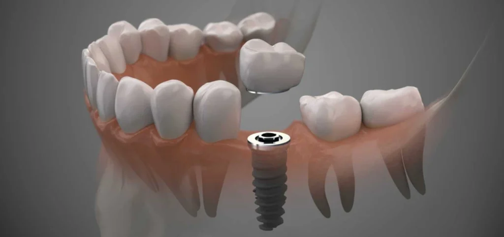implants dentaires - Dentistes à Cannes 06400, sur la Croisette