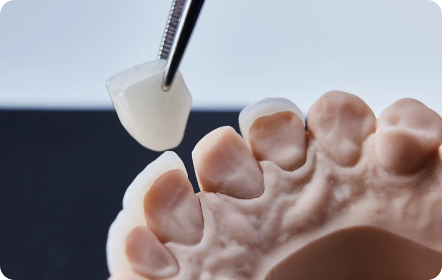 facettes-dentiste-cannes